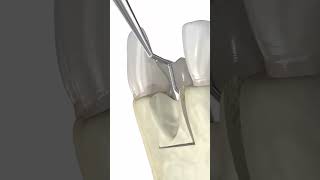 Dental bone graft 3d animation medicalanimation dentalprocedure [upl. by Bruni]