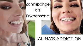 Zahnspange als Erwachsene [upl. by Nonregla164]