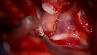 Pterional Craniotomy with Intradural Anterior Clinoidectomy for Clipping of an OphA Aneurysm [upl. by Aphra]