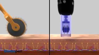 MicroNeedling Procedure Video by Dermapen® [upl. by Deehan]