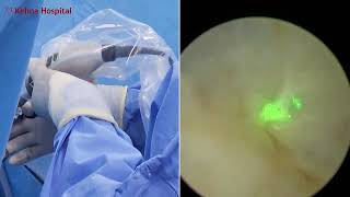 Laser Prostate Surgery HoLEP post UroLift [upl. by Lorene]