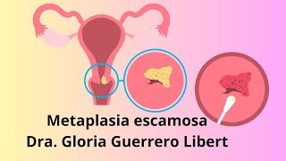 Metaplasia Escamosa en mi papanicolaou ¿Que hacer [upl. by Atahs561]