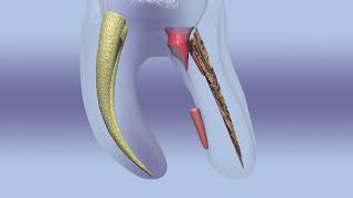 Removal of a gutta percha from a bone refered patient [upl. by Kobi]