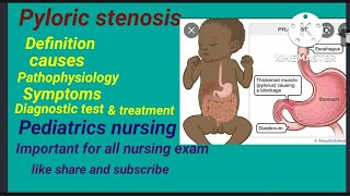 pyloric stenosis  causes  symptoms diagnostic test  treatment  pediatrics nursing Hindi lecture [upl. by Raven]