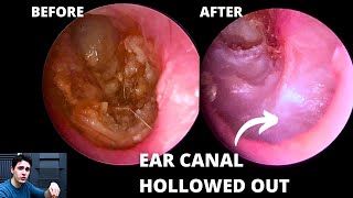 The Importance Of Angled Endoscopes Hidden Pathology [upl. by Erodasi]