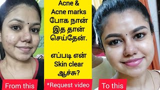 How I cleared my acne  My skincare routine for Acne amp Acne marks  Best products for pimple skin [upl. by Vladamir]