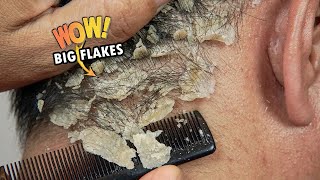 Itchy Psoriasis Scalp Scratching Big Flakes Satisfying 819 [upl. by Aharon]