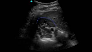 POCUS  Soft Tissue  Lymphadenopathy [upl. by Odama]