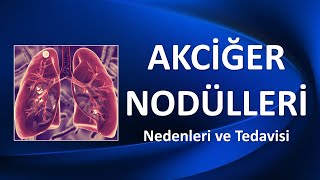 AKCİĞER NODÜLLERİ Nedenleri ve Tedavisi [upl. by Esirahc]