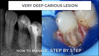 Subgingival Class V We need absolute dam isolation gingivectomy teflon and endodontics [upl. by Icart]