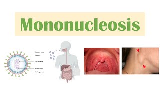 Infectious Mononucleosis Mono  EpsteinBarr Virus Transmission Symptoms Diagnosis Treatment [upl. by Marguerita741]