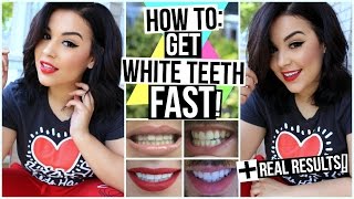 How To Get White Teeth Fast  Before amp After Photos  MakeupbyAmarie [upl. by Fagin]