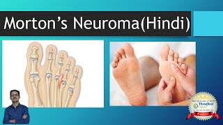 Mortons Neuroma Interdigital Neuroma Hindi Foot Pain and Metatarsalgia [upl. by Aggie122]