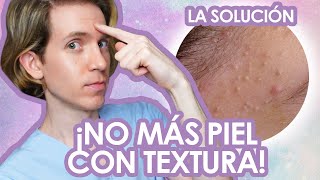 Como ELIMINAR los COMEDONES CERRADOS  Fácil y efectivo  Recomendaciones de un dermatologo [upl. by Hanoy198]