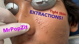 Tight skin acne extractions Comedonal acne with some inflammatory nodules Great session must see [upl. by Gosselin]