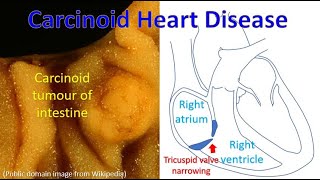 Carcinoid Heart Disease [upl. by Imuya]