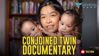 Twins Conjoined At Heart Get Separated  MUST WATCH [upl. by Hammerskjold]