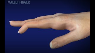 Mallet Finger [upl. by Nich]