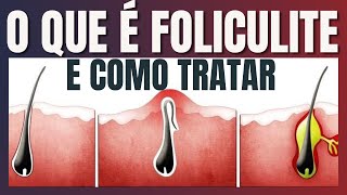 O que é Foliculite e como tratar [upl. by Ellinger]