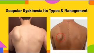 Scapular DyskinesiaWining of Scapula Its types amp Management  PhysiotherapyKnowledge [upl. by Perusse]