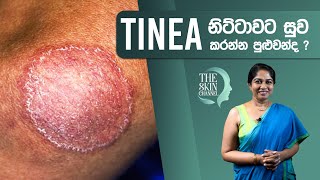 ඔබේ සමටත් දිලීර රෝගයක් Ringworm බෝවෙලාද  Dr Nayani Madarasinghe [upl. by Aronow123]