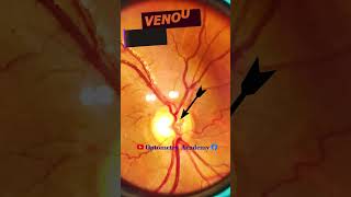 Venous Pulsation  Normal fundus  Normal Retina  Fundus Photography  Short Video 101 optometry [upl. by Yenrab]