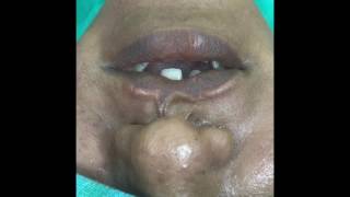 Lip Revision  Bilateral cleft lip scar Revision immediate results [upl. by Eylrac943]