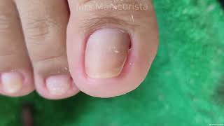 Toenail Ingrown Removal maraming nakuha sa paa ni atepart 2 [upl. by Weingarten]