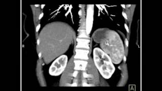 Abdomen Liver Hemangioma of the Liver3 of 8 [upl. by Yaned]