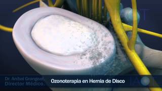 IAOT 3D Ozonoterapia en Hernia de Disco [upl. by Darrick701]