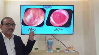 Granular myringitis English Patient teaching programme [upl. by Fugere]