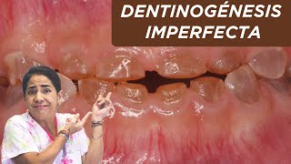 Dentinogénesis imperfecta ¿qué es ¿por qué sucede [upl. by Yllil]