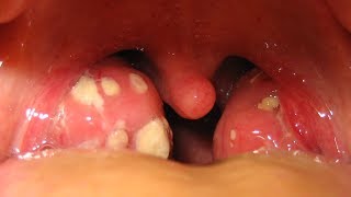 How To Remove Tonsil Stones [upl. by Asiat]