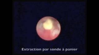 Sialendoscopie extraction par sonde à panier dune lithiase flottante [upl. by Wilone672]