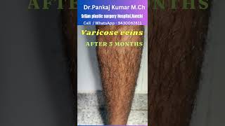 Varicose veins treatment  Result after 3 months Best varicose veins treatment for SSC GD medical [upl. by Niehaus]