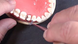 Quick Tip 1  Trimming the Matrix Band [upl. by Yahc]