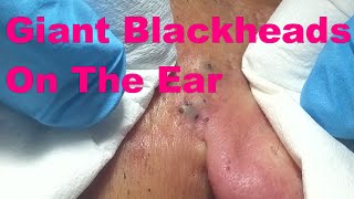 Giant Blackheads  Part I [upl. by Aiouqahs]