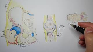 Hematogenous osteomyelitis in children [upl. by Agata]