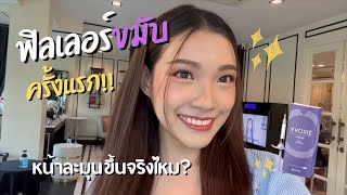 รีวิวละเอียด ลองฉีดฟิลเลอร์ขมับครั้งแรก หน้าละมุนขึ้นจริงไหม ไปดูกัน ดีไหมนะ EP13 [upl. by Onej]