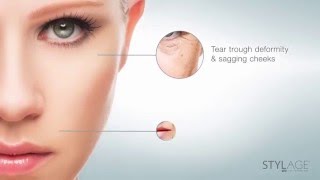 STYLAGE DERMAL FILLERS BY VIVACY [upl. by Anej]