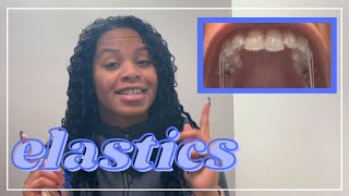 Invisalign 101 Elastics [upl. by Atirac]