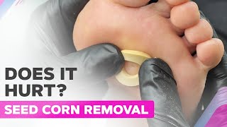 How To Remove a Seed Corn StepByStep Guide [upl. by Ttennaj]