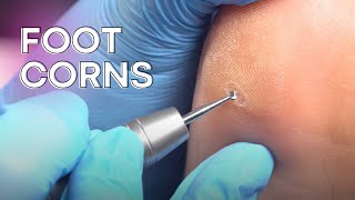 Corn removal and callus reduction  safe and easy [upl. by Arianna165]