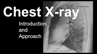 Chest Xray Introduction and Approach [upl. by Ultun307]