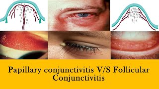 CONJUNCTIVITIS  papillae vs follicles and membranes [upl. by Hgierb]