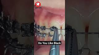 Do You Like Black Elastics bracescolors braces shortvideo shorts [upl. by Lig]