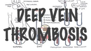 Deep Vein Thrombosis  Overview pathophysiology treatment complications [upl. by Mihe161]