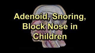 Adenoiditis Adenoid Surgery Snoring Block noseRunny nose in children [upl. by Asenaj]