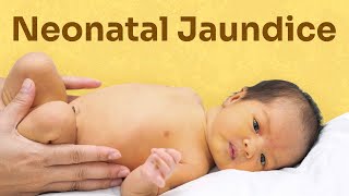 ABO incompatibility leading to neonatal jaundice neonataljaundice ABOincompatibility paediatrics [upl. by Suriaj]