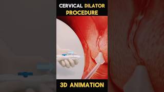 Cervical Dilator Procedures short viral trending cervax surgeon [upl. by Aseral440]